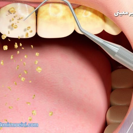 جرم گیری دندان و هزینه آن جرم گیری دندان چیست ؟ جرم‌گیری دندان یکی از روش‌های حفظ بهداشت دهان و دندان است که اساساً به پاکسازی و حذف رسوبات و زباله‌های موجود در سطح دندان‌ها و دور لثه می‌پردازد. این فرآیند از طریق استفاده از ابزارهای ویژه‌ای صورت می‌گیرد که به دندان‌ها و سطوح دهانی نفوذ کرده و رسوبات را از بین می‌برند. جرم‌گیری دندان در اکثر موارد توسط دندان‌پزشکان یا بهداشت دهانی‌ها انجام می‌شود، اما ابزارها و تجهیزات خاصی برای انجام آن در خانه نیز موجود است که برخی افراد ممکن است از آن‌ها استفاده کنند. یکی از مهمترین دلایل جرم‌گیری دندان، پیشگیری از بیماری‌های لثه و تجمع پلاک است. پلاک یک لایه ریز و لطیف است که از ترکیب مواد مختلفی از جمله باکتری‌ها، غذا، و ترکیبات دیگر تشکیل می‌شود. اگر پلاک به طور کامل از دندان‌ها و لثه حذف نشود، می‌تواند باعث التهابات لثه، تجمع بیشتر رسوبات و در نتیجه تسویه آن‌ها به فرمایش دندان، تغییر رنگ دندان‌ها و حتی بوی نامطبوع دهان شود. علاوه بر پیشگیری از بیماری‌ها، جرم‌گیری دندان همچنین می‌تواند به بهبود ظاهر دهان و لبخند افراد کمک کند. با حذف رسوبات و پلاک، رنگ طبیعی دندان‌ها بهبود می‌یابد و براقیت آن‌ها افزایش می‌یابد. این امر می‌تواند به افزایش اعتماد به نفس افراد کمک کرده و باعث بهتر شدن روابط اجتماعی آن‌ها شود. در نتیجه، جرم‌گیری دندان به عنوان یک فرآیند پیشگیری‌ای اساسی در مراقبت از بهداشت دهان و دندان مطرح می‌شود که به بهبود عمومی سلامت دهان و حفظ زیبایی طبیعی آن کمک می‌کند. این فرآیند می‌تواند به دندان‌های سالم‌تر، لثه‌های بهتر و لبخندی زیباتر منجر شود. مراحل جرم گیری دندان جرم گیری دندان به طور کلی شامل چند مرحله می‌شود که به صورت زیر است: 1. بررسی اولیه: این مرحله شامل بررسی اولیه دهان و دندان توسط دندان‌پزشک یا بهداشت‌دهانی می‌باشد. در این مرحله، دندان‌پزشک ممکن است با استفاده از آینه و سوزن به بررسی دندان‌ها، لثه‌ها، و همچنین میزان تجمع پلاک و رسوبات بپردازد تا بتواند نیازهای جرم‌گیری را تعیین کند. 2. تخلیه پلاک و رسوبات: پس از بررسی اولیه، مرحله بعدی تخلیه پلاک و رسوبات از روی دندان‌ها و سطوح دهانی است. این کار اغلب با استفاده از ابزارهای دندانپزشکی مخصوص انجام می‌شود که شامل جرم‌گیرها، اسکریپرها و ابزارهای فرعی دیگر می‌باشد. این ابزارها با کمک دندانپزشک یا بهداشت‌دهانی به طور دقیق پلاک و رسوبات را از سطح دندان‌ها و لثه‌ها حذف می‌کنند. 3. پولیش دندان: پس از حذف پلاک و رسوبات، مرحله بعدی پولیش دندان می‌باشد. در این مرحله، دندانپزشک یا بهداشت‌دهانی از ابزارهایی با سطوح نرم و پولیش کننده استفاده می‌کنند تا سطح دندان‌ها را پولیش و صاف کنند. این کار باعث از بین بردن لکه‌های سطحی، افزایش براقیت دندان‌ها و بهبود ظاهر آن‌ها می‌شود. 4. پایانی کردن مراقبت: در نهایت، پس از انجام جرم‌گیری دندان، دندانپزشک یا بهداشت‌دهانی ممکن است نکات و مراقبت‌های خاصی را به شما برای حفظ بهتر دهان و دندانتان بیان کنند. این ممکن است شامل توصیه‌هایی برای مراقبت منظم، استفاده از محصولات بهداشت دهانی خاص و یا تغییراتی در رژیم غذایی شما باشد. این مراحل برای جرم‌گیری دندان به صورت کلی است و ممکن است بسته به نیازها و وضعیت دهانی هر فرد، تغییر کند. اما این مراحل اساسی راهنمایی می‌کنند که چگونه یک جرم‌گیری دندان موثر و کامل انجام می‌شود. آیا جرم گیری درد دارد؟ عموماً، جرم‌گیری دندان به طور معمول دردی ندارد، اما در برخی موارد ممکن است احساس ناراحتی یا سردردی بعد از انجام جرم‌گیری دندان تجربه شود. دلایل احتمالی این احساسات عبارتند از: 1. لطمه به لثه: هنگام استفاده از ابزارهای جرم‌گیری ممکن است لثه کمی آسیب ببیند یا تحریک شود که موجب ناراحتی موقت می‌شود. این ناراحتی معمولاً بعد از چند روز خود به خود کاهش می‌یابد. 2. حساسیت دندانی: اگر دندان‌های شما حساسیت دارند، ممکن است در اثر تماس ابزار جرم‌گیری با دندان‌های حساس، ناراحتی ایجاد شود. در این صورت، استفاده از پاست دندان حساسیت یا معاوضه با دندان‌پزشک در مورد مشکل مناسب است. 3. تحریک عضلات چانه: حرکات ابزار جرم‌گیری ممکن است به عضلات چانه فشار و تحریک بیشتری وارد کند که باعث سردرد موقت یا ناراحتی در منطقه چانه شود. 4. استفاده از مخدر موضعی: در برخی موارد، دندانپزشک ممکن است قبل از جرم‌گیری دندان، مخدر موضعی مانند ژل یا اسپری مخدر را بر روی لثه‌ها و دندان‌ها اعمال کند تا ناراحتی را کاهش دهد. به طور کلی، بیشتر افراد پس از جرم‌گیری دندان هیچ احساسی ندارند یا احساس ناراحتی کمی دارند که در مدت کوتاهی کاهش می‌یابد. اگر احساس ناراحتی شدید یا مشکلی پس از جرم‌گیری دندان ادامه داشت، بهتر است با دندانپزشک خود مشورت کنید. هزینه جرم گیری چقدر است؟ قیمت جرم گیری دندان معمولاً بین ۱,۵۰۰,۰۰۰ تا ۲,۵۰۰,۰۰۰ تومان (یک میلیون و پانصد هزار تومان تا دو میلیون و پانصد هزار تومان) است. این قیمت ممکن است بسته به نوع روش جرم گیری دندان متغیر باشد، اما در حدود این مقدار است. لیست قیمت جرم گیری در مطب دکتر میرموئینی در جدول زیر، هزینه‌های جرم گیری دندان در سال ۱۴۰۳ بر اساس نوع درمان آورده شده است: • جرم گیری دندان یک فک: شروع قیمت از ۷۵۰,۰۰۰ تومان • جرم گیری دندان دو فک: شروع قیمت از ۱,۵۰۰,۰۰۰ تومان • هزینه جرم گیری لثه: ۱,۷۰۰,۰۰۰ تومان • هزینه جرم گیری زیر لثه: ۱,۷۰۰,۰۰۰ تومان • هزینه جرم گیری با ایرفلو: ۲,۵۰۰,۰۰۰ تومان • هزینه بروساژ دندان: ۸۰۰,۰۰۰ تومان • هزینه جرم گیری دندان با بیمه تامین اجتماعی (برای هر دو فک): ۹۰۰,۰۰۰ تومان • هزینه جرم گیری و بروساژ دندان: ۱,۶۰۰,۰۰۰ تومان • هزینه جرم گیری و پولیش دندان: ۱,۷۰۰,۰۰۰ تومان مزایای جرم گیری دندان جرم‌گیری دندان یکی از مراقبت‌های مهم در حوزه بهداشت دهان و دندان است که به طور فزاینده‌ای مورد توجه قرار گرفته است. در زیر به مزایای جرم‌گیری دندان می‌پردازیم: 1. پیشگیری از بیماری‌های لثه و دهانی: یکی از مهمترین مزایای جرم‌گیری دندان پیشگیری از بیماری‌های لثه و دهانی است. با حذف پلاک، رسوبات و باکتری‌های موجود در دهان، احتمال ابتلا به بیماری‌هایی مانند التهاب لثه و جیوه را کاهش می‌دهد. بدون جرم‌گیری منظم، پلاک می‌تواند به ترکیبات شیمیایی خطرناکی تبدیل شود که باعث التهاب و آسیب دهنده برای بافت‌های لثه می‌شوند. 2. بهبود عمومی سلامت دهان و دندان: جرم‌گیری دندان به بهبود عمومی سلامت دهان و دندان کمک می‌کند. با پاکسازی پلاک و رسوبات از روی دندان‌ها و لثه‌ها، رنگ و براقیت دندان‌ها بهبود می‌یابد و بوی نامطبوع دهان کاهش می‌یابد. همچنین، جرم‌گیری دندان می‌تواند به پیشگیری از تسویه و فرماندهی رسوبات دندان کمک کرده و در نتیجه ازدیاد تسویه آن‌ها و ایجاد تغییرات زیبایی در دهان جلوگیری کند. 3. کاهش احتمال ابتلا به بیماری‌های دهانی و جانبی: جرم‌گیری دندان به طور مستقیم می‌تواند احتمال ابتلا به بیماری‌های دهانی و جانبی را کاهش دهد. بیماری‌های دهانی مانند التهاب لثه، جیوه و بیماری‌های جانبی مانند بیماری‌های قلبی و عفونت‌های باکتریایی در دهان ممکن است با عدم مراقبت و تجمع پلاک و رسوبات تشدید شوند. به طور کلی، جرم‌گیری دندان بهبود عملکرد دهان و دندان، و در نتیجه، بهبود عمومی سلامت بدن را نیز تضمین می‌کند. به طور خلاصه، جرم‌گیری دندان مزایای بسیاری برای بهداشت دهان و دندان و همچنین سلامت کلی بدن دارد. این فرآیند به پیشگیری از بیماری‌ها، بهبود ظاهر دندان‌ها و کاهش احتمال ابتلا به بیماری‌های دهانی و جانبی کمک می‌کند. پیشگیری از جرم گرفتن دندان پیشگیری از جرم‌گیری دندان و حفظ بهداشت دهانی بسیار مهم است و می‌تواند از وقوع بیماری‌های دهانی و دندانی و همچنین نیاز به درمان‌های پیشگیری‌نشده جلوگیری کند. در زیر به برخی روش‌های پیشگیری از جرم‌گیری دندان اشاره می‌کنیم: 1. مراقبت‌های دهانی روزانه: برای جلوگیری از تشکیل پلاک و رسوبات، مراقبت‌های دهانی منظم و صحیح از جمله مسواک زدن حداقل دو بار در روز، استفاده از مسواک با سر نرم و مناسب، مصرف نخ دندانی برای تمیز کردن فضای میان دندان‌ها و استفاده از آب دهان شوی‌های ضد باکتری می‌تواند بسیار مؤثر باشد. 2. رژیم غذایی سالم: مصرف غذاهایی که غنی از قند و اسیدهای جمع کننده‌ی دندان هستند را محدود کنید. انواع مواد غذایی شیرین و اسیدی می‌توانند باعث تشدید تشکیل پلاک و رسوبات شوند. برعکس، مصرف مواد غذاییی مانند سبزیجات و میوه‌های تازه که غنی از فیبر و آب هستند، به پاکسازی دهان و افزایش تولید بزاق کمک می‌کنند. 3. مراجعه به دندان‌پزشک به صورت دوره‌ای: مراجعه به دندان‌پزشک برای بررسی‌ها و جرم‌گیری‌های دوره‌ای می‌تواند کمک کننده باشد. این اقدام به شناسایی زودهنگام مشکلات دهانی و دندانی مانند تسویه پلاک و رسوبات، پیشگیری از تشکیل دندان‌های پوسیده و ارائه راهنمایی‌های مرتبط با بهداشت دهان و دندان می‌پردازد. 4. توجه به علائم بیماری‌های دهانی: هرگونه علائم غیرعادی مانند خونریزی لثه، تورم لثه، بوی نامطبوع دهان و یا درد دندان باید جدی گرفته شود و باید به دندان‌پزشک مراجعه شود. این علائم ممکن است نشان‌دهنده وجود بیماری‌های جدی دهانی و دندانی باشند که نیاز به درمان دارند. با انجام این روش‌ها و توجه به نکات بهداشت دهانی، می‌توانید از جرم‌گیری دندان پیشگیری کنید و به حفظ سلامت دهان و دندان‌های خود کمک کنید. انواع جرم گیری دندان جرم‌گیری دندان یکی از مراحل اساسی در حفظ بهداشت دهان و دندان است و به منظور حذف پلاک و رسوبات از روی سطح دندان‌ها و لثه‌ها صورت می‌گیرد. این فرآیند می‌تواند با استفاده از ابزارهای مختلف و تکنیک‌های متنوع انجام شود. در زیر به برخی از انواع جرم‌گیری دندان اشاره می‌کنیم: 1. جرم‌گیری دندان با دستیاری: در این روش، دندانپزشک یا بهداشت دهانی از ابزارهای دستی شامل جرم‌گیر، اسکریپر و ماساژور لثه استفاده می‌کنند تا پلاک و رسوبات را از روی سطح دندان‌ها و لثه‌ها حذف کنند. این روش معمولاً برای جرم‌گیری معمولی و در مواردی که پلاک و رسوبات کمتری وجود دارد، استفاده می‌شود. 2. جرم‌گیری دندان با اولتراسونیک: در این روش، ابزارهای جرم‌گیری اولتراسونیک با فرکانس‌های بالا برای لغزش پلاک و رسوبات از سطح دندان‌ها و لثه‌ها استفاده می‌شود. این روش معمولاً برای پلاک و رسوبات مقداری سخت‌تر و یا برای مواردی که نیاز به جرم‌گیری عمیق‌تری دارند، مورد استفاده قرار می‌گیرد. 3. جرم‌گیری دندان با لیزر: استفاده از لیزر برای جرم‌گیری دندان نسبتاً جدیدتر است. در این روش، ابزار لیزری با قدرت و دقت بالا برای حذف پلاک و رسوبات از سطح دندان‌ها و لثه‌ها استفاده می‌شود. این روش معمولاً برای جرم‌گیری دقیق و حساس و همچنین در مواردی که نیاز به حفظ بافت‌های نرم استفاده می‌شود. 4. جرم‌گیری دندان با فراصوت: در این روش، ابزارهایی که امواج فراصوتی تولید می‌کنند برای جرم‌گیری دندان استفاده می‌شود. این امواج فراصوتی به طور موثر پلاک و رسوبات را لغزش می‌دهند و از سطح دندان‌ها و لثه‌ها حذف می‌کنند. این روش معمولاً برای جرم‌گیری دقیق و حساس و همچنین در مواردی که نیاز به حفظ بافت‌های نرم استفاده می‌شود. این تنها چند روش از انواع مختلف جرم‌گیری دندان هستند. هر روشی ممکن است بر اساس نیازها و شرایط خاص فرد، توسط دندانپزشک یا بهداشت دهانی انتخاب شود. نحوه انجام جرمگیری دندان چگونه است؟ جرم‌گیری دندان یک فرآیند مهم در حفظ بهداشت دهان و دندان است که به منظور حذف پلاک و رسوبات از سطح دندان‌ها و لثه‌ها صورت می‌گیرد. این فرآیند ممکن است توسط دندانپزشک یا بهداشت دهانی انجام شود. اولین گام در انجام جرم‌گیری دندان بررسی اولیه دهان و دندان توسط پزشک است. در این مرحله، پزشک بررسی می‌کند که آیا پلاک و رسوبات بیشتری وجود دارد یا نه. پس از بررسی اولیه، مرحله بعدی جرم‌گیری دندان استفاده از ابزارهای جرم‌گیری مخصوص است. این ابزارها شامل جرم‌گیرها، اسکریپرها، ماساژورهای لثه و دیگر ابزارهای مرتبط می‌باشند. پزشک با دقت این ابزارها را بر روی سطح دندان‌ها و لثه‌ها حرکت داده و پلاک و رسوبات را از سطح دندان‌ها و لثه‌ها حذف می‌کند. پس از حذف پلاک و رسوبات، مرحله بعدی پولیش دندان است. در این مرحله، ابزارهایی با سطوح نرم و پولیش کننده برای صاف کردن سطح دندان‌ها و بهبود براقیت آن‌ها استفاده می‌شود. این مرحله باعث از بین رفتن لکه‌های سطحی و افزایش زیبایی و رنگ طبیعی دندان‌ها می‌شود. در نهایت، پس از انجام جرم‌گیری دندان، پزشک ممکن است نکات و راهنمایی‌هایی را برای حفظ بهداشت دهان و دندان به شما ارائه کند. این نکات ممکن است شامل راهنمایی‌هایی برای مراقبت منظم، استفاده از محصولات بهداشت دهانی مناسب و یا تغییراتی در رژیم غذایی شما باشد. بروساژ چیست؟ بروساژ یک فرآیند است که در زمینهٔ زیبایی و بهداشت دهان و دندان انجام می‌شود و به معنای پولیش کردن و صاف کردن سطح دندان‌ها به منظور حذف لکه‌ها، رسوبات و ترکیباتی است که باعث زوال و آسیب دهنده‌ی سطح دندان می‌شوند. این فرآیند می‌تواند با استفاده از ابزارهای مخصوص به انجام برسد یا از طریق فرآیندهای شیمیایی که لکه‌ها و رسوبات را از سطح دندان‌ها حذف می‌کنند، صورت گیرد. بروساژ دندان معمولاً به دو روش انجام می‌شود: روش مکانیکی و روش شیمیایی. در روش مکانیکی، ابزارهای خاصی مانند برس‌ها و پاست‌های خاص برای صاف کردن سطح دندان‌ها و حذف لکه‌ها و رسوبات استفاده می‌شوند. این ابزارها با سرعت و فشار مناسب بر روی سطح دندان‌ها حرکت می‌کنند تا آلودگی‌ها را از دندان‌ها حذف کنند. در روش شیمیایی، از مواد شیمیایی خاصی مانند اسیدها و مواد حاوی آبسوربانت برای حذف لکه‌ها و رسوبات استفاده می‌شود. این مواد شیمیایی می‌توانند پلاک را حل کرده و ذرات آلودگی را از سطح دندان‌ها جدا کنند. بروساژ دندان می‌تواند بهبودی بسیار زیادی در ظاهر و پوشیدگی دندان‌ها ایجاد کند. آنچه که به ویژه مهم است این است که پس از انجام بروساژ، بهداشت دهان و دندان منظم حفظ شود تا از تجمع مجدد لکه‌ها و رسوبات جلوگیری شود. آیا جرمگیری دندان خطرناک است جرم‌گیری دندان، اگر به درستی و توسط حرفه‌ایان مجرب انجام شود، خطرناک نیست و بلکه یکی از مراحل اساسی در حفظ بهداشت دهان و دندان است. این فرآیند به منظور حذف پلاک و رسوبات از روی سطح دندان‌ها و لثه‌ها انجام می‌شود و در واقع، جلوگیری از تجمع پلاک و رسوبات می‌تواند به بیماری‌های دندانی و لثه‌ای مانند پوسیدگی دندان‌ها، التهاب لثه و جیوه از طریق کاهش باکتری‌های موجود در دهان کمک کند. بنابراین، انجام جرم‌گیری دندان به صورت منظم و دوره‌ای توسط دندانپزشک یا بهداشت دهانی می‌تواند به حفظ سلامت دهان و دندان و جلوگیری از بروز مشکلات دهانی و دندانی کمک کند. همچنین، با انجام مراقبت‌های منظم و دقیق خانگی مانند مسواک زدن و استفاده از نخ دندانی، می‌توان از تجمع پلاک و رسوبات در دندان‌ها جلوگیری کرد و نیاز به جرم‌گیری دندان در مطب دندانپزشک را کاهش داد. به طور کلی، جرم‌گیری دندان از جمله فعالیت‌هایی است که باید به صورت دوره‌ای و با رعایت استانداردهای بهداشتی انجام شود و اگر به درستی انجام شود، خطری برای سلامت دندان‌ها نخواهد داشت. اما در صورت انجام نادرست یا از سوی افراد غیرحرفه‌ای، ممکن است باعث آسیب به ساختار دندان‌ها و لثه‌ها شود. چرا دندان پس از جرمگیری حساس است؟ پس از انجام جرم‌گیری دندان، بعضی افراد ممکن است حساسیتی در دندان‌های خود تجربه کنند. این حساسیت معمولاً به دلیل تحریک ناخواسته و موقتی نرم‌افزارهای عصبی درون دندان‌ها ناشی از فشار و تحریک ابزارهای جرم‌گیری یا ابزارهای شیمیایی مورد استفاده برای حذف پلاک و رسوبات از سطح دندان‌ها است. در اثر این تحریکات، کانال‌های حسی دندان‌ها که از طریق آنها اطلاعات حسی به مغز منتقل می‌شود، ممکن است به طور موقت به شدت حساس شوند. این حساسیت معمولاً در برابر تحریکات مانند گرما، سرما، فشار یا اثرات شیمیایی احساس می‌شود و باعث ناراحتی می‌شود. علاوه بر این، در مواردی که پلاک و رسوبات به طور ژل‌وار در سطح دندان‌ها تجمع کرده‌اند و پس از جرم‌گیری از بین رفته‌اند، لایه‌هایی از لایه نرم و محافظی که از مواد معدنی مانند انامل و فلورید تشکیل شده‌اند، ممکن است در معرض تخریب قرار بگیرند. این مواد معدنی به عنوان یک نوع سپر محافظتی برای دندان‌ها عمل می‌کنند و حفاظت از آسیب‌های خارجی مانند اسیدهای حاصل از تجزیه غذاها را بر عهده دارند. بنابراین، حساسیت پس از جرم‌گیری دندان معمولاً موقتی است و در اکثر موارد پس از چند روز به طور خودکار کاهش می‌یابد. اما اگر حساسیت به مدت طولانی ادامه داشت یا بسیار شدید بود، بهتر است با دندانپزشک خود مشورت کنید تا علت آن را تشخیص دهید و درمان مناسب انجام شود. هرچند وقت یکبار لازم است جرمگیری انجام شود؟ فرکانس جرم‌گیری دندان بستگی به عوامل متعددی دارد از جمله وضعیت بهداشت دهان و دندان فرد، سابقه پلاک و رسوبات دندانی، عوامل خوراکی و رفتارهای بهداشت دهانی شخصی. به طور کلی، برخی از افراد نیاز به جرم‌گیری دندان را به صورت مکررتر نسبت به دیگران دارند. در حالت عمومی، توصیه می‌شود که جرم‌گیری دندان حداقل دو بار در سال توسط دندانپزشک انجام شود. اما برخی از افراد ممکن است نیاز داشته باشند که این فرآیند را بیشتر از دو بار در سال انجام دهند، به خصوص اگر دارای عوامل خطری مانند تجمع بیشتر پلاک، تاریخچه بیماری‌های دهانی و دندانی، یا نقص‌های دندانی باشند. علاوه بر جرم‌گیری دوره‌ای توسط دندانپزشک، مراقبت‌های منظم و بهداشت دهانی خانگی نیز بسیار مهم است. استفاده منظم از مسواک و نخ دندانی، استفاده از آب دهان شوی‌های ضد باکتری، مصرف غذاهای سالم و کاهش مصرف مواد شیرین و اسیدی می‌تواند به حفظ سلامت دهان و دندان کمک کند و نیاز به جرم‌گیری دوره‌ای را کاهش دهد. در نهایت، بهتر است با دندانپزشک خود مشورت کنید تا برنامه مراقبتی مناسبی برای حفظ بهداشت دهان و دندان خود تنظیم کنید، او می‌تواند بر اساس وضعیت شما و نیازهای خاص شما توصیه‌هایی برای فرکانس مناسب جرم‌گیری دندان ارائه دهد. مراقبت های بعد از جرم گیری دندان پس از جرم‌گیری دندان، مراقبت‌های مناسبی را می‌توانید انجام دهید تا بهبودی سریع‌تر و بهتری را تجربه کنید و از حساسیت و عوارض پس از این فرآیند جلوگیری کنید. در زیر به برخی از مراقبت‌های مهم پس از جرم‌گیری دندان اشاره شده است: 1. استفاده از محصولات ضد حساسیت: پس از جرم‌گیری دندان، ممکن است دندان‌های شما حساسیت بیشتری نسبت به حرارت و سرما تجربه کنند. در این صورت، می‌توانید از محصولات ضد حساسیت مانند خمیر دندان یا آب دهان شوی‌های حاوی فلورید استفاده کنید تا به کاهش حساسیت کمک شود. 2. مراقبت دهانی منظم: ادامه دادن به مراقبت دهانی منظم و روزانه، شامل مسواک زدن حداقل دو بار در روز و استفاده از نخ دندانی برای پاکسازی فضای میان دندان‌ها، می‌تواند به حفظ بهداشت دهان و دندان شما کمک کند و از تجمع مجدد پلاک و رسوبات جلوگیری کند. 3. مصرف غذاهای نرم و سرد: در روزهای اولیه پس از جرم‌گیری دندان، بهتر است از مصرف غذاهای نرم و سرد مانند موز، ماست یا بستنی پرهیز کنید. این اقدام به کاهش تحریک دندان‌ها کمک می‌کند و به حفظ راحتی شما کمک می‌کند. 4. مشاوره با دندانپزشک: در صورتی که حساسیت یا ناراحتی پس از جرم‌گیری دندان به طور مداوم ادامه دارد، بهتر است به دندانپزشک خود مراجعه کنید تا علت این مشکل را بررسی کرده و راهکارهای مناسبی را برای حفظ سلامت دهان و دندان شما تعیین کند. با رعایت این مراقبت‌ها، می‌توانید پس از جرم‌گیری دندان بهبودی سریع‌تری را تجربه کرده و از سلامتی بهتری برخوردار شوید. فواید جرم‌گیری دندان جرم‌گیری دندان یکی از مراحل اساسی در حفظ بهداشت دهان و دندان است و دارای فواید متعددی است که می‌توان به آن اشاره کرد. در زیر به برخی از فواید اصلی جرم‌گیری دندان اشاره می‌کنیم: 1. حفظ سلامت دهان و دندان: جرم‌گیری دندان به دوره‌ای حذف پلاک و رسوبات از روی سطح دندان‌ها و لثه‌ها می‌پردازد، که این کار باعث کاهش خطر ابتلا به بیماری‌های دهانی و دندانی مانند پوسیدگی دندان‌ها، التهاب لثه و جیوه می‌شود. 2. پیشگیری از عفونت‌های دهانی: با حذف پلاک و رسوبات، احتمال ابتلا به عفونت‌های دهانی کاهش می‌یابد. برخی از این عفونت‌ها می‌توانند به عوارض جدی‌تری مانند عفونت‌های لثه، جیوه و حتی اختلالات قلبی-عروقی منجر شوند. 3. کاهش حساسیت دندانی: جرم‌گیری دندان می‌تواند به کاهش حساسیت دندانی ناشی از تجمع پلاک و رسوبات کمک کند. با حذف این لایه‌های آلودگی‌زایی، دندان‌ها حساسیت کمتری نسبت به تحریکات خارجی مانند گرما، سرما و فشار نشان می‌دهند. 4. بهبود زیبایی دهان: پلاک و رسوبات معمولاً باعث تیرگی و لکه‌های سطحی در دندان‌ها می‌شوند. با حذف این تیرگی‌ها و لکه‌ها، زیبایی و براقیت طبیعی دندان‌ها بهبود می‌یابد و لبخند شما جذاب‌تر می‌شود. 5. حفظ تونای لثه: جرم‌گیری دندان می‌تواند به حفظ تونای لثه کمک کند. پلاک و رسوبات ممکن است باعث التهاب و تحریک لثه شوند که در نتیجه می‌تواند منجر به تورم و خونریزی لثه شود، اما با حذف آن‌ها این خطرات کاهش می‌یابد. با این توضیحات، مشخص است که جرم‌گیری دندان نقش بسیار مهمی در حفظ سلامت دهان و دندان دارد و انجام این فرآیند به صورت منظم می‌تواند به بهبود عمومی سلامت دهان و دندان کمک کند. خونریزی لثه بعد از جرم‌ گیری خونریزی لثه پس از جرم‌گیری دندان ممکن است در برخی افراد رخ دهد و اغلب نشان‌دهنده‌ی وجود مشکلاتی در لثه‌ها است. این خونریزی معمولاً ناشی از تحریک لثه‌ها به دست ابزارهای جرم‌گیری یا ازمایش‌های دندانپزشکی است. در زیر به برخی از علل و راهکارهای مدیریت خونریزی لثه پس از جرم‌گیری دندان اشاره می‌کنیم: 1. التهاب لثه: در برخی از افراد، التهاب لثه ممکن است قبل از جرم‌گیری دندان وجود داشته باشد و در اثر تحریک و فشار ابزارهای جرم‌گیری، لثه‌ها به طور فزاینده‌ای خونریزی کنند. این مسئله ممکن است به عنوان نشانه‌ای از وجود التهاب لثه نیازمند توجه و درمان مداوم باشد. 2. ترک یا زخم لثه: در برخی موارد، ترک‌ها یا زخم‌های کوچک در لثه‌ها ممکن است به دست ابزارهای جرم‌گیری ایجاد شود که باعث خونریزی شوند. این موارد معمولاً به صورت خودبخودی بهبود می‌یابند، اما در صورتی که خونریزی مداوم باشد یا تورم و درد ایجاد شود، بهتر است به دندانپزشک خود مراجعه کنید. 3. استفاده از ابزارهای ناشی از آسیب: استفاده از ابزارهای ناشی از آسیب مانند برس‌های سخت یا استفاده نادرست از ابزارهای جرم‌گیری می‌تواند به آسیب و تحریک لثه‌ها منجر شود که این موارد باعث خونریزی می‌شوند. بهتر است از ابزارهای نرم و ملاحظه شده برای جرم‌گیری استفاده کنید تا به آسیب دیدگی لثه‌ها جلوگیری شود. در کل، خونریزی لثه پس از جرم‌گیری دندان معمولاً موقتی است و در اکثر موارد تحت کنترل است. اما در صورتی که خونریزی به صورت مداوم ادامه داشته یا با علایم دیگری همراه باشد، بهتر است به دندانپزشک خود مراجعه کرده و وضعیت را بررسی کنید. عوامل موثر در هزینه جرم گیری دندان چیست؟ هزینه جرم‌گیری دندان به عوامل متعددی وابسته است که می‌تواند تأثیر بسزایی بر قیمت نهایی این خدمت داشته باشد. این عوامل شامل موارد زیر می‌شود: 1. موقعیت جغرافیایی: در برخی مناطق و شهرها، هزینه‌های خدمات دندانپزشکی ممکن است بالاتر یا پایین‌تر از مناطق دیگر باشد. فراهم بودن زیرساخت‌های بهداشتی، هزینه‌های اجاره مطب، و هزینه‌های زندگی متفاوت در هر منطقه می‌تواند به اختلاف در هزینه جرم‌گیری دندان منجر شود. 2. سطح تخصص و تجربه دندانپزشک: دندانپزشکان با سطح تخصص و تجربه بالاتر ممکن است هزینه‌های بیشتری برای خدمات خود دریافت کنند. همچنین، درمان‌هایی که توسط دندانپزشکان متخصص و با تجربه انجام می‌شود، ممکن است کیفیت بالاتری داشته باشد که این نیز می‌تواند به افزایش هزینه منجر شود. 3. میزان پلاک و رسوبات: در صورتی که پلاک و رسوبات بیشتری بر روی دندان‌ها تجمع کرده باشند، ممکن است نیاز به زمان و تلاش بیشتری برای جرم‌گیری دندان وجود داشته باشد که این نیز می‌تواند به افزایش هزینه منجر شود. 4. نیاز به انجام اقدامات دیگر: در برخی موارد، نیاز به انجام اقدامات دیگر همزمان با جرم‌گیری دندان ممکن است وجود داشته باشد، مانند پر کردن دندان‌ها یا انجام رادیوگرافی. این اقدامات اضافی می‌تواند به افزایش هزینه کل خدمات دندانپزشکی منجر شود. در نهایت، هزینه جرم‌گیری دندان به عوامل مختلفی بستگی دارد و برای تعیین هزینه دقیق، بهتر است با دندانپزشک خود مشاوره کنید و مشخص کنید که چه عواملی در هزینه خدمات شما تأثیرگذار خواهند بود. جرم گیری روی کامپوزیت، لمینت یا ایمپلنت بله، می‌توان جرم‌گیری روی کامپوزیت، لمینت و ایمپلنت انجام داد، اما با روش‌ها و مواد مناسب برای هر کدام از این نوع‌های دندان‌پزشکی. در ادامه توضیح داده می‌شود: 1. کامپوزیت: کامپوزیت‌ها موادی هستند که برای پر کردن مواد دندانی مفقود یا تخریب شده استفاده می‌شوند. این مواد به طور عمومی حساسیت کمتری نسبت به دندان‌های طبیعی دارند. جرم‌گیری روی سطح کامپوزیت می‌تواند به کاهش ترسیم و لکه‌های سطحی کمک کند و باعث حفظ زیبایی و براقیت طبیعی آنها شود. 2. لمینت دندانی: لمینت‌ها یا پوسته‌های نازکی هستند که بر روی سطح دندان‌ها قرار می‌گیرند و بهبود ظاهر و زیبایی دندان‌ها را فراهم می‌کنند. جرم‌گیری روی سطح لمینت‌ها باید با مواد نرم و ملاحظه شده انجام شود تا از آسیب به این پوسته‌های نازک جلوگیری شود. 3. ایمپلنت دندانی: ایمپلنت‌ها ساختارهای جایگزین برای دندان‌های از دست رفته هستند که در فک جایگزین می‌شوند. جرم‌گیری در اطراف ایمپلنت‌ها بسیار مهم است تا از تجمع پلاک و رسوبات در این ناحیه و از دست دادن سلامت ایمپلنت جلوگیری شود. انتخاب ابزارها و روش‌های مناسب برای جرم‌گیری اطراف ایمپلنت بسیار حائز اهمیت است. در هر صورت، برای انجام جرم‌گیری روی این نوع دستگاه‌های دندانی، بهتر است از دندانپزشک خود مشورت بگیرید تا روش‌ها و مواد مناسبی را برای حفظ سلامت و زیبایی این دستگاه‌ها انتخاب کنید. علت ایجاد جرم دندان جرم دندان معمولاً ناشی از ترکیبی از عوامل مختلف است که شامل تجمع باکتری‌ها، تجمع پلاک، تغذیه نامناسب، نقص‌های بهداشت دهانی و عوامل ژنتیکی است. باکتری‌ها یکی از عوامل اصلی جرم دندان هستند؛ زیرا آنها در دهان حضور دارند و در اثر تغذیه‌ی بر روی باقیمانده‌ی غذا و قند، اسید تولید می‌کنند که باعث انحلال و ضعف اندام‌های دندانی می‌شود. پلاک دندانی یک لایه‌ی بی رنگ و لزج است که در صورت عدم تمیزی دندان‌ها تشکیل می‌شود. این پلاک باعث ایجاد جرم دندان می‌شود زیرا باعث تشکیل بستری برای رشد باکتری‌ها می‌شود و به عنوان یک محل آماده برای تجمع رسوبات معدنی از غذاها عمل می‌کند. در صورتی که پلاک به مدت طولانی بر روی سطح دندان‌ها باقی بماند، ممکن است به پلاک سخت تبدیل شود و به عنوان سنگ‌های دندانی یا رسوبات دندانی شناخته شود که با انجام جرم‌گیری دندان از بین می‌روند. همچنین، عوامل مانند تغذیه نامناسب و نقص‌های بهداشت دهانی می‌توانند به افزایش خطر جرم دندان منجر شوند. مصرف غذاهای پرقند و اسیدی، نه تنها باعث تولید اسیدهای ضرربخش توسط باکتری‌ها می‌شود بلکه می‌تواند به افزایش تجمع پلاک و رسوبات دندانی منجر شود. همچنین، نقص‌های بهداشت دهانی مانند عدم استفاده منظم از مسواک و نخ دندانی، عدم انجام جرم‌گیری دندان به موقع، و عدم مراقبت از دندان‌های مصنوعی می‌توانند به افزایش خطر جرم دندان منجر شوند. به طور کلی، جرم دندان نتیجه‌ای از ترکیبی از عوامل است که شامل باکتری‌ها، پلاک دندانی، تغذیه نامناسب، نقص‌های بهداشت دهانی و عوامل ژنتیکی می‌باشد. برای پیشگیری از جرم دندان، مراقبت منظم از دهان، انجام جرم‌گیری دندان به موقع و رعایت نکات بهداشتی مهم است. جرم دندان در کدام قسمت ها وجود دارد؟ جرم دندان معمولاً در نقاط مختلف دهان و بر روی سطوح مختلف دندان‌ها قرار می‌گیرد. این جرم‌ها به طور عمده در موارد زیر قابل مشاهده هستند: 1. سطح دندان‌ها: جرم دندان به طور معمول بر روی سطح دندان‌ها تجمع می‌یابد. پلاک دندانی که از ترکیب باکتری‌ها، باقیمانده‌های غذایی و سایر مواد تشکیل شده است، به طور نامحسوس روی سطح دندان‌ها شکل می‌گیرد و باعث ایجاد لایه‌ی رسوبی می‌شود که به صورت یک لایه‌ی لزج و مات شناخته می‌شود. 2. فضای میان دندانی: جرم دندان می‌تواند در فضای میان دندانی نیز تجمع یابد. این اما به طور معمول بین دندان‌های همسایه و در نواحی دشوارتر قابل دسترسی است و ممکن است نیاز به استفاده از نخ دندانی یا پالپوت دهانی داشته باشد تا این جرم‌ها پاک شوند. 3. پایه‌های دندان و لثه‌ها: جرم دندان می‌تواند در محل‌های پایه‌ی دندان و لثه‌ها نیز یافت شود. این موارد معمولاً به عنوان پلاک لثه شناخته می‌شوند که ممکن است باعث التهابات لثه و تورم شوند. 4. دندان‌های مصنوعی: حتی در صورت داشتن دندان‌های مصنوعی مانند ایمپلنت‌ها یا پلمپ‌ها، جرم دندان می‌تواند در محل‌های مختلف اطراف این دندان‌ها تجمع یابد و باعث عوارضی مانند التهابات لثه یا پوسیدگی دور دندان‌های مصنوعی شود. به طور کلی، جرم دندان در نقاط مختلف دهان مانند سطح دندان‌ها، فضای میان دندانی، پایه‌های دندان و لثه‌ها و حتی در اطراف دندان‌های مصنوعی می‌تواند وجود داشته باشد و برای حفظ بهداشت دهان و دندان، اهمیت بسیاری دارد که این جرم‌ها به موقع و موثر از بین برود. آیا جرم گیری دندان را خراب میکند ؟ جرم‌گیری دندان یک فرآیند اساسی در حفظ بهداشت دهان و دندان است که به صورت منظم توسط دندانپزشکان انجام می‌شود. این فرآیند به عنوان یکی از روش‌های اصلی پیشگیری از بیماری‌های دهانی و دندانی مانند پوسیدگی، التهاب لثه و جیوه شناخته می‌شود. با این حال، اگر جرم‌گیری دندان به نحوی نامناسب یا ناصحیح انجام شود، ممکن است به برخی مشکلات منجر شود. اما این نکته مهم است که انجام جرم‌گیری دندان توسط یک دندانپزشک ماهر و با استفاده از روش‌ها و ابزارهای مناسب، به طور کلی به صورت مضر نیست و به برقراری بهداشت دهان و دندان کمک می‌کند. یکی از مسائلی که ممکن است به نظر برسد جرم‌گیری دندان را خراب می‌کند، ایجاد زخم یا تحریک لثه‌ها و بافت‌های نرم اطراف دندان است. اگر جرم‌گیری با استفاده از ابزارهای نازک و تیز به نحوی نامناسب انجام شود، ممکن است باعث آسیب به لثه‌ها و بافت‌های اطرافی شود که می‌تواند به التهابات و خونریزی لثه منجر شود. این مشکلات معمولاً با تجربه و مهارت دندانپزشکان در جلوگیری از آسیب به لثه‌ها و بافت‌های نرم اطراف دندان کاهش می‌یابد. علاوه بر این، استفاده از ابزارهای نامناسب یا نامنظمی در جرم‌گیری دندان ممکن است منجر به آسیب دندانی شود. این آسیب‌ها می‌توانند شامل زخم‌ها یا شکستگی‌های سطح دندان، آسیب به روکش طبیعی دندان و حتی تخریب ناخن‌های لثه شوند. اما با استفاده از ابزارهای مناسب و با رعایت اصول بهداشتی، این خطرات قابل کاهش است و جرم‌گیری دندان می‌تواند به صورت ایمن و مؤثر انجام شود. در نهایت، باید توجه داشت که جرم‌گیری دندان به نحوه‌ای نامناسب و ناصحیح انجام شود، ممکن است به مشکلاتی منجر شود. اما اگر این فرآیند توسط دندانپزشکان ماهر و با استفاده از ابزارها و روش‌های مناسب انجام شود، جرم‌گیری دندان می‌تواند به صورت ایمن و مؤثر برای حفظ بهداشت دهان و دندان انجام شود. آیا جرم گیری دندان را نازک میکند ؟ جرم‌گیری دندان به طور معمول دندان را نازک نمی‌کند. در واقع، این فرآیند به عنوان یکی از روش‌های اصلی حفظ بهداشت دهان و دندان مورد تأیید دندانپزشکان است. جرم‌گیری دندان به معنای از بین بردن پلاک، رسوبات معدنی و سایر مواد زائدی است که بر روی سطح دندان‌ها تجمع می‌یابند و می‌تواند به پوسیدگی، التهاب لثه، جیوه و سایر مشکلات دهانی و دندانی منجر شود. به طور کلی، جرم‌گیری دندان به جای ایجاد نازکی در دندان‌ها، به صورت معمول به حفظ سلامت و قوی ماندن آنها کمک می‌کند. با از بین بردن پلاک و رسوبات، دندان‌ها به طور عمده از خطراتی مانند پوسیدگی و التهابات لثه محافظت می‌شوند. به علاوه، با کاهش تجمع پلاک و رسوبات، قابلیت تغذیه‌ی باکتری‌ها کاهش می‌یابد و احتمال ایجاد بیماری‌های دهانی و دندانی نیز کاهش می‌یابد. با این حال، اگر جرم‌گیری دندان به نحوی نامناسب انجام شود و باعث آسیب به دندان‌ها یا بافت‌های اطرافی شود، ممکن است به نازکی دندان‌ها منجر شود. بنابراین، اهمیت دارد که این فرآیند توسط دندانپزشکان ماهر و با استفاده از ابزارها و روش‌های مناسب انجام شود تا به سلامت و قوی ماندن دندان‌ها کمک کند.