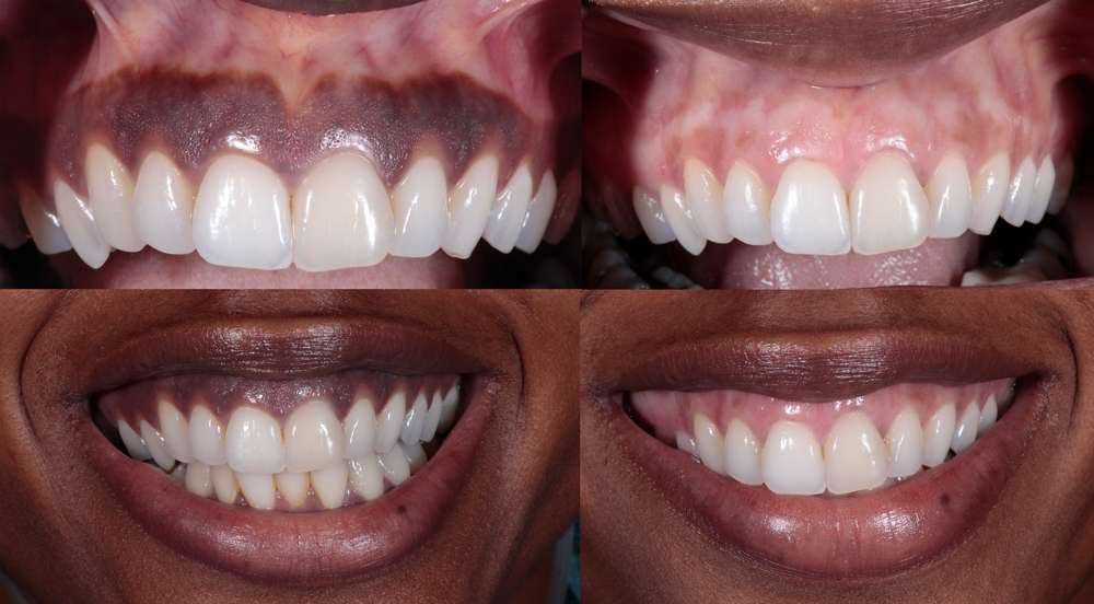 why dark gums in Los Angeles, CA