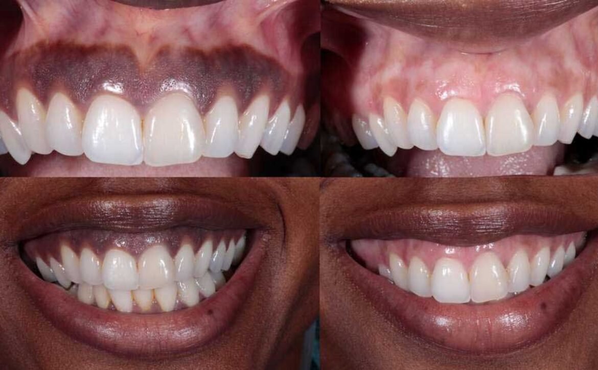 why dark gums in Los Angeles, CA