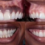 کمبود چه ویتامینی باعث سیاه شدن لثه می شود