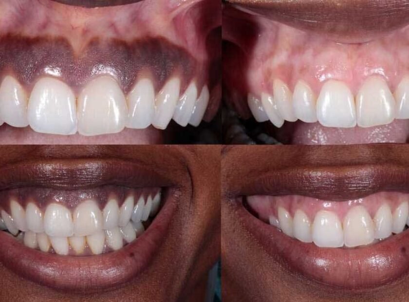 why dark gums in Los Angeles, CA